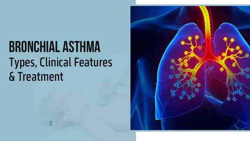 Bronchial Asthma Βρογχικό άσθμα προκαλεί περιορισμό του αέρα και μεταβαλλόμενη στένωση των βρόγχων