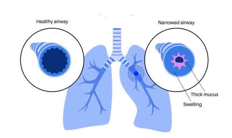 Bronchial Asthma Βρογχικό άσθμα προκαλεί περιορισμό του αέρα και μεταβαλλόμενη στένωση των βρόγχων 2 βρογχικό άσθμα ετερογενής νόσος