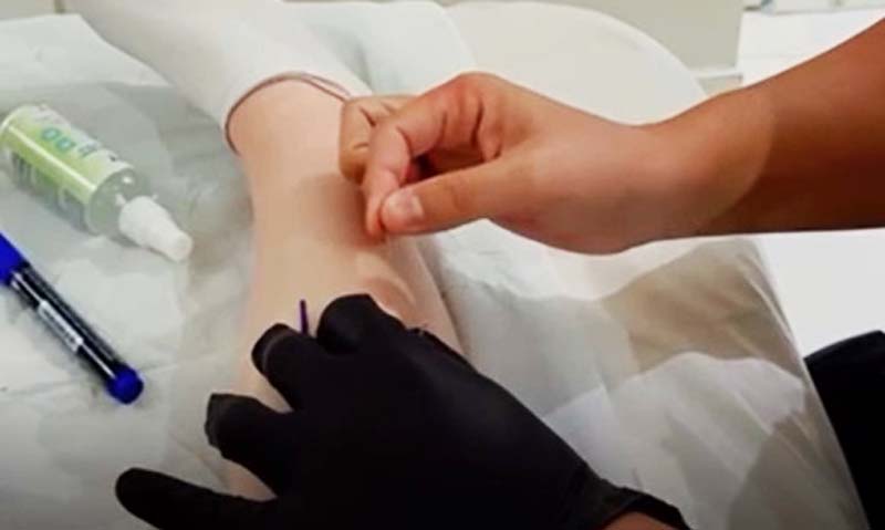 Dry Needling Ξηρός Βελονισμός: Σύγχρονη v.1 μέθοδος για άμεση ανακούφιση από μυϊκό πόνο 2 Dry Needling
