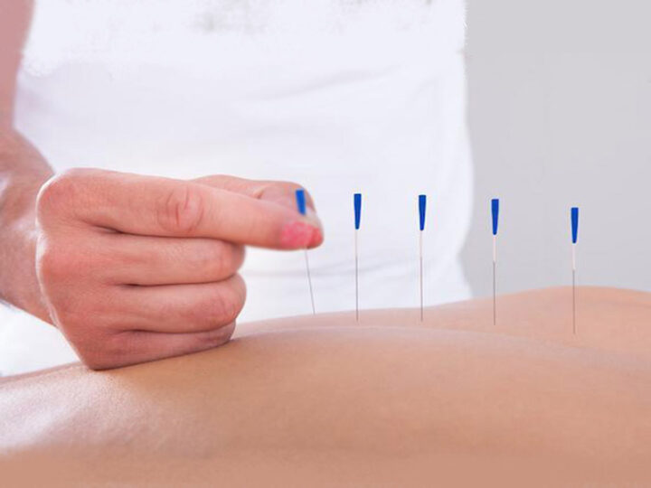 Dry Needling Ξηρός Βελονισμός: Σύγχρονη v.1 μέθοδος για άμεση ανακούφιση από μυϊκό πόνο
