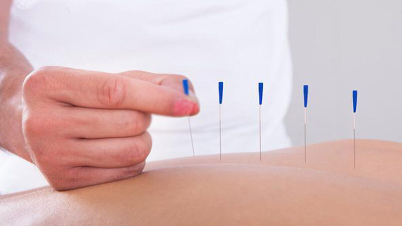 Dry Needling Ξηρός Βελονισμός: Σύγχρονη v.1 μέθοδος για άμεση ανακούφιση από μυϊκό πόνο