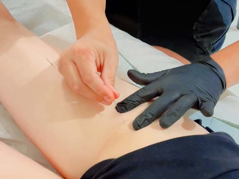 Dry Needling Ξηρός Βελονισμός: Σύγχρονη v.1 μέθοδος για άμεση ανακούφιση από μυϊκό πόνο 4 Ξηρός Βελονισμός Η νέα τάση για χαλάρωση και ευεξία
