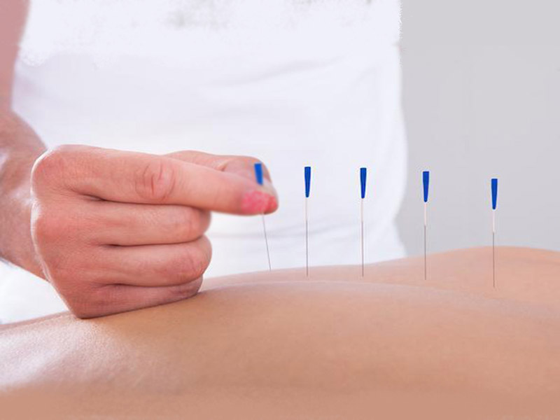 Dry Needling Ξηρός Βελονισμός: Σύγχρονη v.1 μέθοδος για άμεση ανακούφιση από μυϊκό πόνο